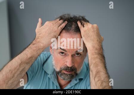 Man Checking His Hair Loss And Dandruff Stock Photo