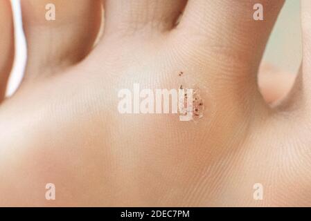 wart on a blunt close-up. Macro shot of human papilloma on the foot Stock Photo