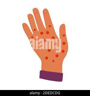 hand with Allergy. Skin covered destruction with red rash, psoriasis, atopy, eczema of epidermis severe allergic dermatitis. Vector. Stock Vector