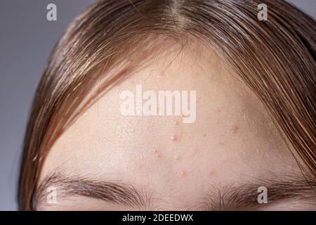 Acne on the forehead of a teenage girl - skin problems in children, acne treatment in dermatology Stock Photo