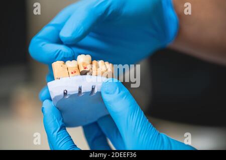 Dental prosthesis, dentures, prosthetics work. Prosthetics hands while working on the denture. Stock Photo