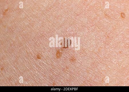 Papilloma on human skin - benign tumor in the form of mole, nevus, tumor. Papillomatosis Stock Photo