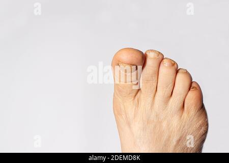 Fungus of nails on the big toe - dermatomycosis and onychomycosis, fungal infection macro photo. Dermatology, treatment of nail mycosis. Stock Photo