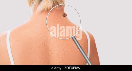 Magnifying glass showing mole on elderly woman skin. Preventive examination of a nevus on the human body Stock Photo