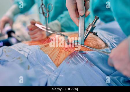 Surgeon Inserting Tube Into Patient During Surgery Stock Photo