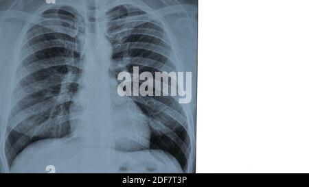 X-ray of human lungs on isolated white background. X-ray close-up Stock Photo