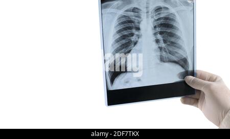 Lung x-ray isolated on white, picture of human lungs, doctor holding x-ray. Stock Photo