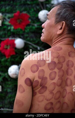Vietnam, Can Tho, cupping therapy Stock Photo