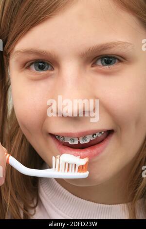 Orthodontics, braces, tooth brushing Stock Photo