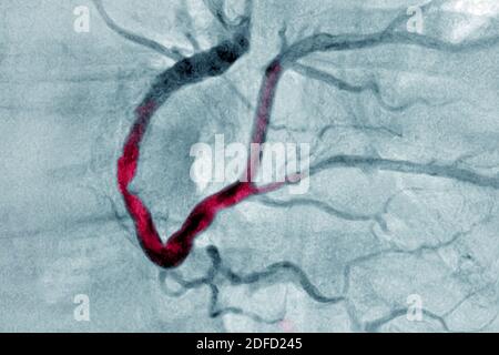 Myocardial infarction with a significant thrombus in the right coronary artery and extends into the left retro ventricular and the posterior intervent Stock Photo