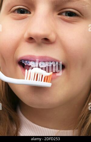 Braces, tooth brushing Stock Photo