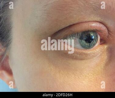 Swollen eyelid due to allergy Stock Photo
