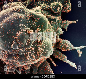Colorized scanning electron micrograph of an apoptotic cell (green) heavily infected with SARS-COV-2 virus particles (orange), isolated from a patient Stock Photo
