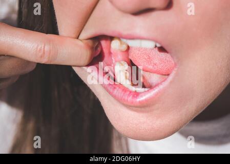 Young woman with open mouth without tooth on lower jaw. Missing tooth. Waiting an implant after tooth extraction Stock Photo