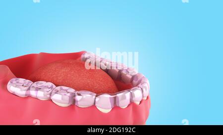 silicone braces on the display stand 3d render on blue gradient Stock Photo