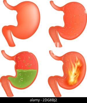 Vector Medical illustration of realistic stomach outside and inside. Gastritis and acid reflux, indigestion and stomach pain problems. Stock Vector