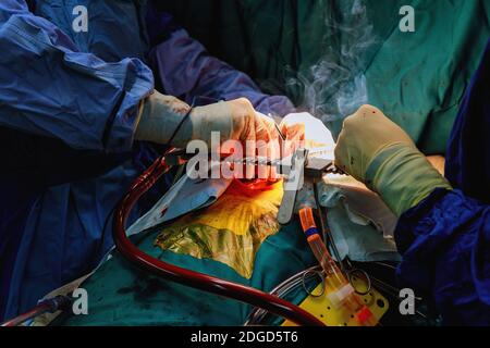 Surgeon surgery and team perform thoracic surgery in case lung cancer Stock Photo