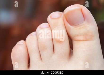 A young woman has hard corns and calluses on her toes from wearing shoes that uncomfortable and don't fit properly. Female foot. Close up view. Stock Photo