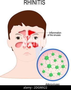 Viral sinusitis (Rhinitis) caused by adenovirus infection. Face with nasal cavity and close-up viral infection that caused this disease Stock Vector