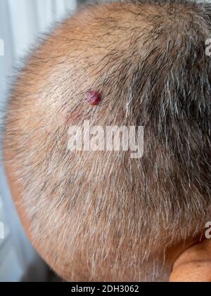 A skin mole normally as a result of exposure to ultraviolet light which can develop into Melanoma, a type of skin cancer. Stock Photo