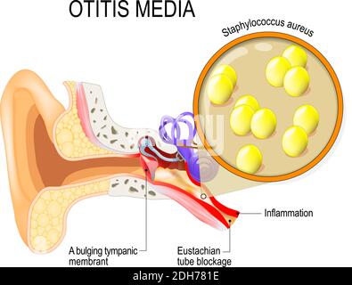 Otitis media is inflammation of the middle ear. bacterial infections disease. Close up of  Staphylococcus aureus. Human anatomy. illustration Stock Vector