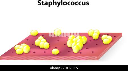 staphylococcus colonies on the skin surface. Vector illustration Stock Vector