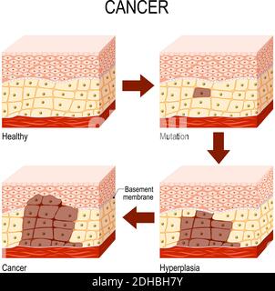 developing cancer. from Normal cells to Mutation, Hyperplasia, and Malignant tumor. Neoplasia. Vector diagram for educational, medical, biological Stock Vector