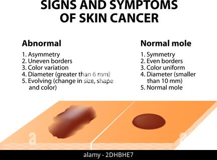 Skin cancer: Squamous cell carcinoma (disease of older cells on the ...