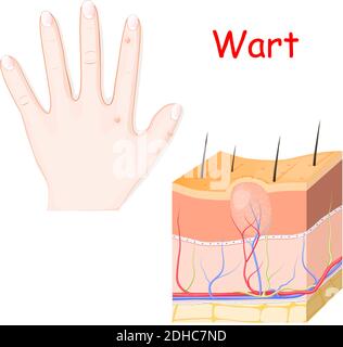 warts on a hand. cross section of detailed wart. Vector illustration for medical use Stock Vector