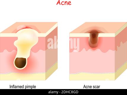 Acne treatment. Cross section of the human skin with Inflamed pimple and Acne scar. Stock Vector