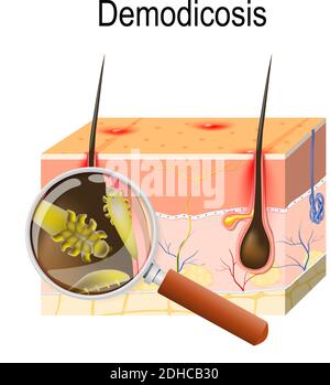 Demodicosis, called demodectic mange or red mange. Cross section of the skin with mites. Close-up demodex through magnifying glass Stock Vector