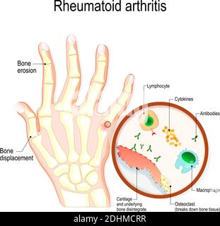 Rheumatoid Arthritis (RA) is an auto immune disease and inflammatory type of arthritis that usually affects joints. hand with rheumatoid arthritis Stock Vector