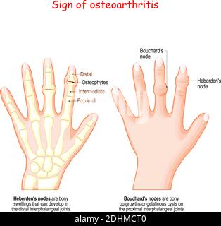 OSTEOARTHRITIS, ILLUSTRATION Stock Photo - Alamy