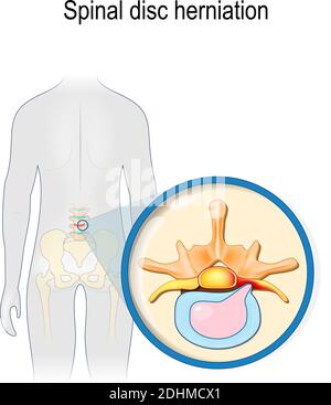 Spinal disc herniation. Back pain. Human silhouette with highlighted (red color) lumbar spine and Pelvis. Prolapse of intervertebral disc close-up Stock Vector