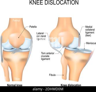 Knee dislocation and normal. Lateral trauma to the knee, torn collateral ligaments, cruciate ligament injury and meniscus injury. Human anatomy Stock Vector