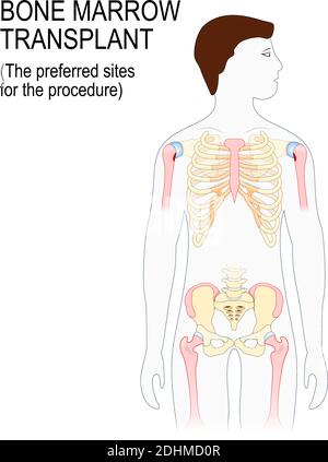 bone marrow transplant. The preferred sites for the transplantation procedure (Sternum, iliac crest, tibia or femur). man silhouette with highlighted Stock Vector