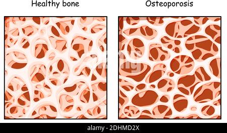 Healthy bone and Osteoporosis in comparison isolated on a white background. disease of bones that leads to an increased risk of fracture. low density Stock Vector