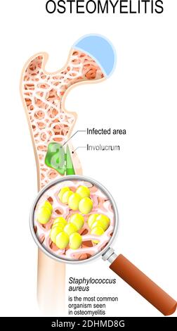 Osteomyelitis is infection in the bone. Close-up bacteria (Staphylococcus aureus) that caused this disease. Vector diagram Stock Vector