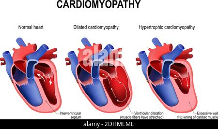 vector illustration of heart disease, defect. cardiology Stock Vector ...