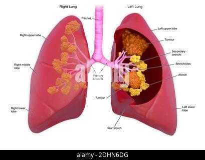 Annotated illustration of human lungs. The lungs transport oxygen into ...