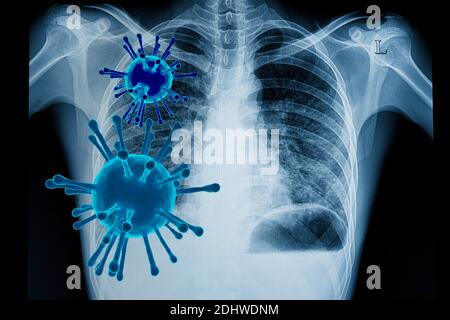 Visual illustration of coronavirus (covid-19) infection in the lungs with 3D rendered viral particles and a chest xray film of a patient with bilatera