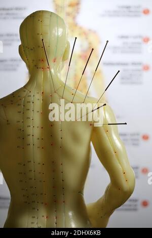 male acupuncture model with needles in the right shoulder Stock Photo