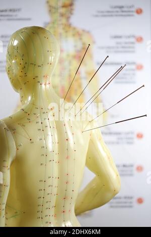 male acupuncture model with needles in the right shoulder Stock Photo