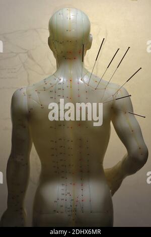 male acupuncture model with needles in the right shoulder Stock Photo