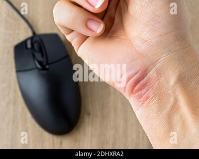 Redness and callus or corn on the wrist of a caucasian woman's hand, caused by long work with the mouse at the computer. Occupational diseases. Stock Photo