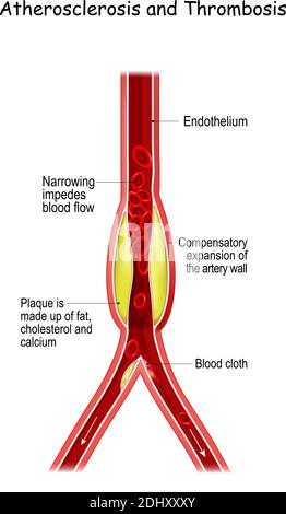 Atherosclerosis and Thrombosis. Thrombus formation in an atherosclerotic vessel. The rupture of an atherosclerotic plaque is start of thrombosis. Stock Vector