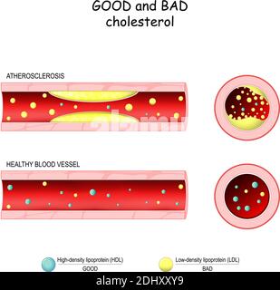 good (HDL) and bad (LDL) cholesterol. Healthy blood vessel and Atherosclerosis. Cross section of blood vessel. Low-density, High-density lipoprotein Stock Vector