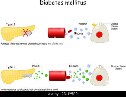 Types of diabetes mellitus. Stock Vector