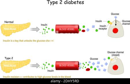 Types 2 of Diabetes Mellitus. Comparison of cell work in diabetes and in a healthy body. Insulin resistance contributes to high glucose levels Stock Vector