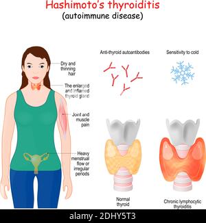 Hashimoto's thyroiditis. chronic lymphocytic thyroiditis is an autoimmune disease in which the thyroid gland is gradually destroyed Stock Vector